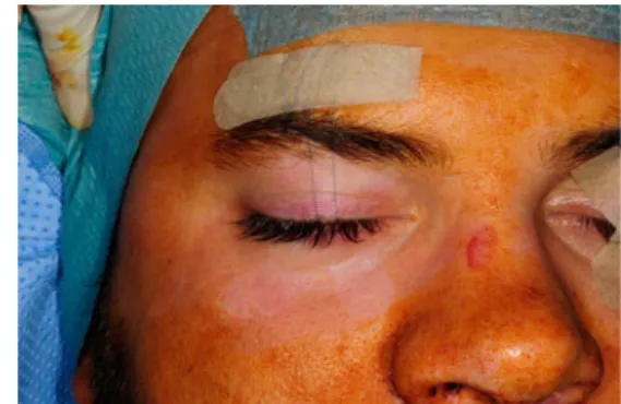 Fig. 1 Frost suture in place and taped to the supraorbital skin