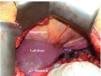 Fig. 1 Intraperitoneal transdiaphragmatic access to the heart: loca- loca-tion of the incision (red line)