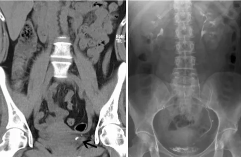 Abb. 1  8  CT inkonklusiv: Steinverdacht (Pfeil) – in der intravenösen Urographie (IVU) eindeutig: 