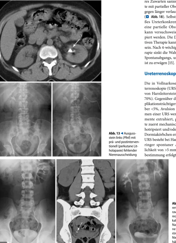 Abb. 14  9  Fehlende Nie-  Fehlende Nie- renausscheidung in der int-ravenösen Urographie (IVU)   rechts. In der CT prävesi-kales Konkrement (Pfeil).   Nach Ureterrenoskopie (oh-ne Zuwarten infolge der  röntgenologisch stummen   Niere) reguläre Abflussver-h