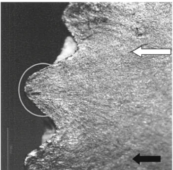 Fig. 3 Lines (black arrow) radiate semi circularly from the lateral groove (circle). A crack radiating from the lines may be noted (white arrow) indicating fatigue fracture