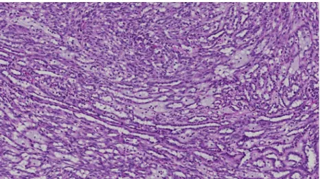 Fig. 1 Mucinous tubular and spindle-cell carcinoma showing classical pattern with elongated tubules, spindle-cell areas, and stromal mucin