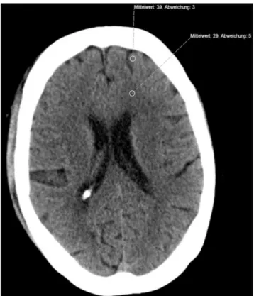 Table 1  Technical parameters of the examination protocols that were  used on the three scanners for standard brain studies