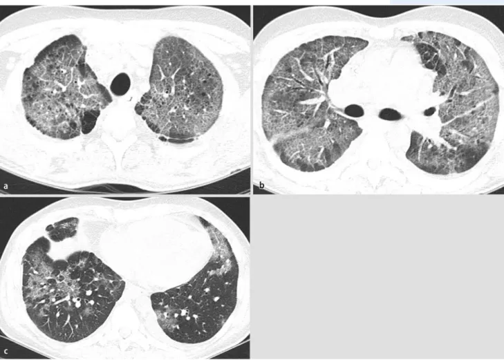 Abb. 8  8  a,b,c Die axialen CT-Bilder der Lunge desselben Patienten wie in .  Abb. 7 demonstrieren die typischen  bilateralen retikulären Transparenzminderungen und Milchinfiltrate bei PCP mit Aussparung der basalen Anteile