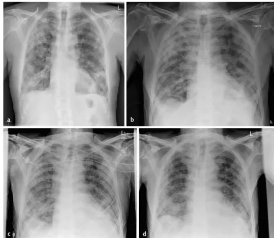 Abb. 3  8  Patient mit Cyclophosphamidtherapie bei systemischem Lupus erythematodes: Die Serie von Röntgen- Röntgen-bildern des Thorax im Abstand von je 3 Tagen (a,b,c) bzw