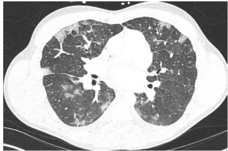 Abb. 6  8  Das axiale Computertomographiebild der Lunge des Patienten  aus  .  Abb. 5 stellt die für die eosinophile Pneumonie typischen, peripher  betonten (Milchglas-)Infiltrate dar