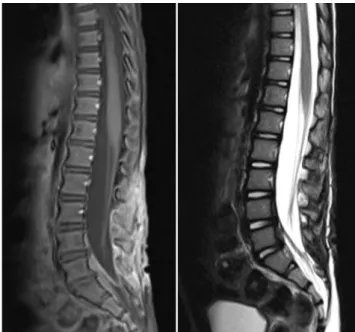 Fig. 3 Sagittal T1-weighted (left) and T2-weighted (right) lumbar MRI at 3-month follow-up, after the laminoplasty and the antibiotic therapy, showing a complete radiological healing