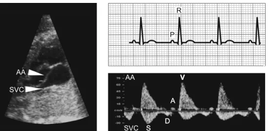 Fig. 1 Left, Two-dimensional ultrasound image showing the anatomical proximity of the SVC and the AA