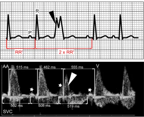 Fig. 3 Upper panel, surface ECG: VPB is diagnosed when a wide premature QRS complex (black arrowhead) is observed on surface ECG