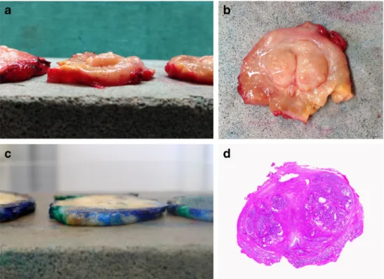 Fig. 4 a Adenocarcinoma of the prostate, H&amp;E. b Diffuse cytoplasmic positivity for PSA