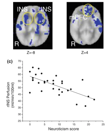 Fig. 5 Axial perfusion images with clusters demonstrating a signif- signif-icant negative correlation with neuroticism overlaid in blue (a).
