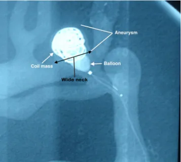 Fig. 3 Balloon remodeling technique application in a wide-necked aneurysm