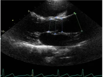Fig. 1 Long-axis view of ascending aorta. Four measurement levels: