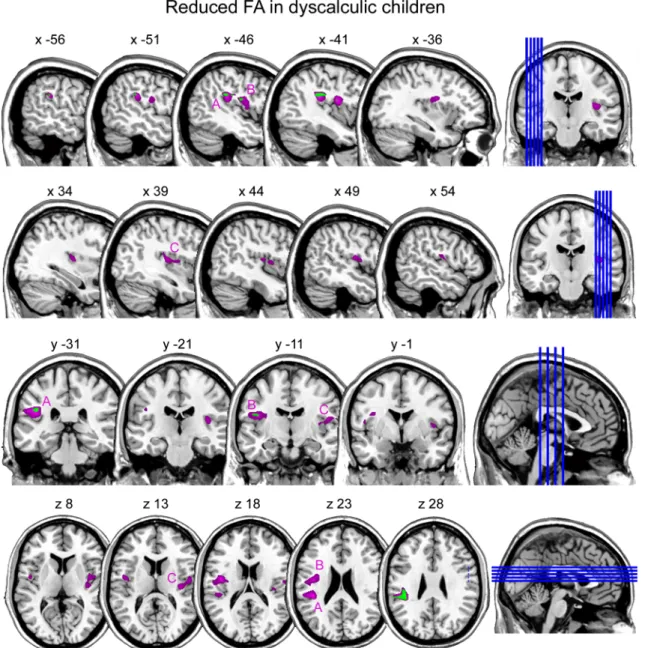 Fig. 1 Sagittal slices of the left and right hemisphere, coronal and axial slices illustrate regions in pink where children with DD show reduced fractional anisotropy (FA) compared to control children at p \ 0.001 corrected for multiple comparisons: a left