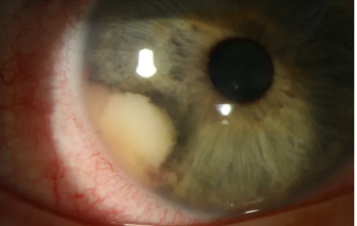 Abb. 1  7  Klinisches  Bild des rechten Auges  mit grauweißer 