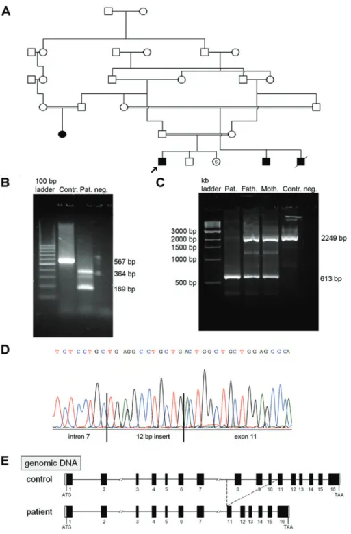 Figure 1: (A) Pedigree of the index patient (arrow) with triple A syndrome; (B–E) characterization of the novel AAAS indel mutation on  genomic and mRNA level: (B) RT-PCR analysis on RNA from patient (Pat.) and control (Contr.) cells