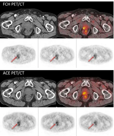 Fig. 1 Three-phase FCH and three-phase ACE PET/CT showing concordant local recurrence (arrows)