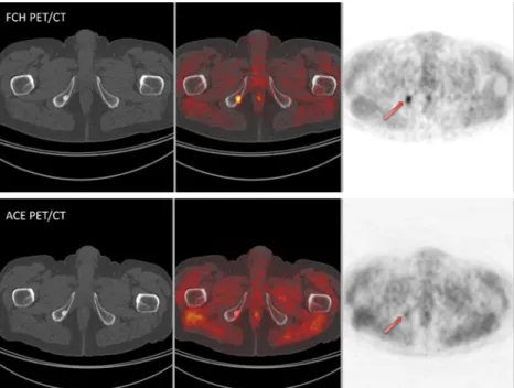 Fig. 3), a thyroid nodule (confirmed by ultrasound imaging and biological evaluation as a parathyroid adenoma), a lung tumour (confirmed by follow-up CT imaging as a stable nodule), and a supraclavicular lymph node (visible on CT images and probably unrela