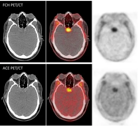 Fig. 3 Pituitary gland concordantly positive on  whole-body FCH and ACE PET/CT acquisitions corresponding to a macroadenoma