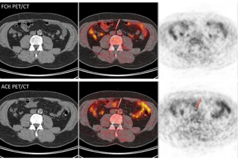 Table 5 SUVmax values and TBR for positive findings on ACE or FCH PET/CT or both