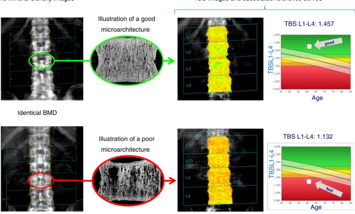 Fig. 1 Generating TBS for healthy versus osteoporotic bone