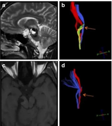 Fig. 5 Illustrative case V . Preoperative T2-W sagittal MR image (a) with cavernous malformation in the right part of the pons