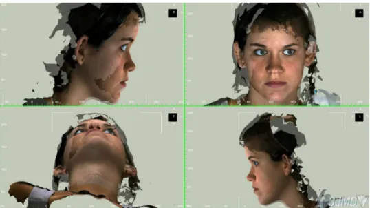 Fig. 4 Fusion of the real postoperative three-dimensional (3D) photograph and the computer-generated soft tissue prediction