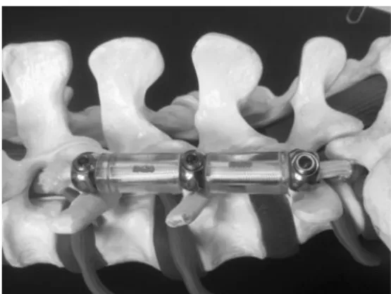 Fig. 1 Postero-lateral view of a two-level Dynesys sawbone model
