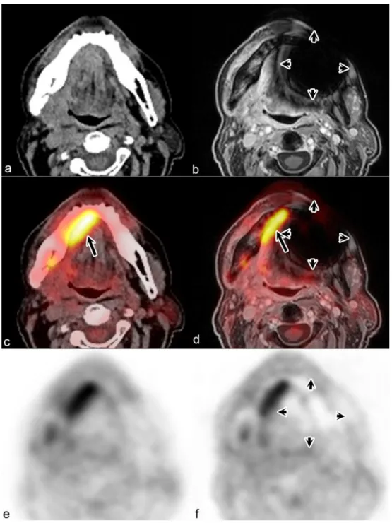 Fig. 2 Degraded PET/MR image quality due to dental implants in a 50-year-old woman with recurrent squamous cell carcinoma T3N0M0 of the oral cavity