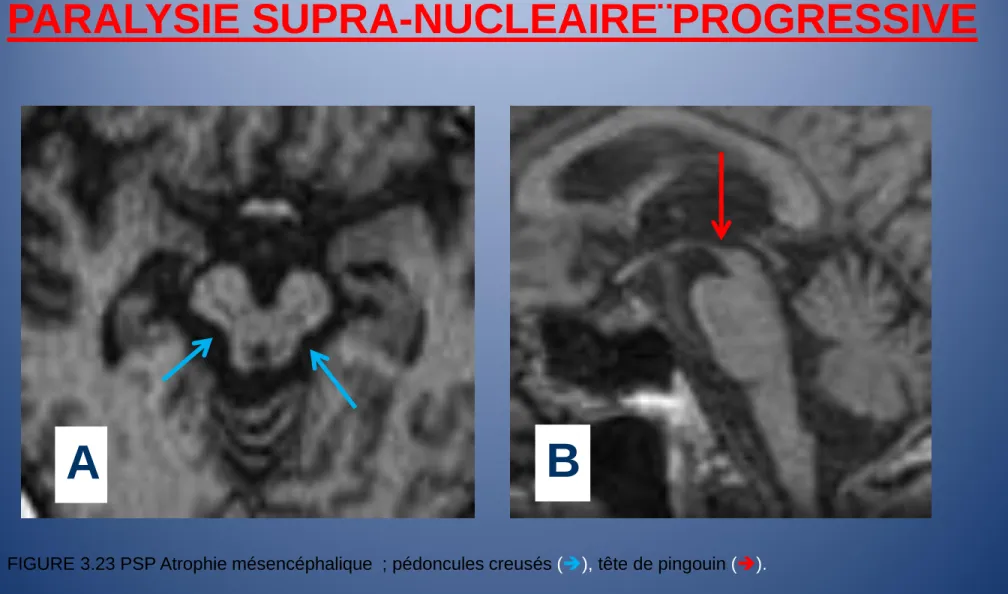 FIGURE 3.23 PSP Atrophie mésencéphalique  ; pédoncules creusés (), tête de pingouin ()