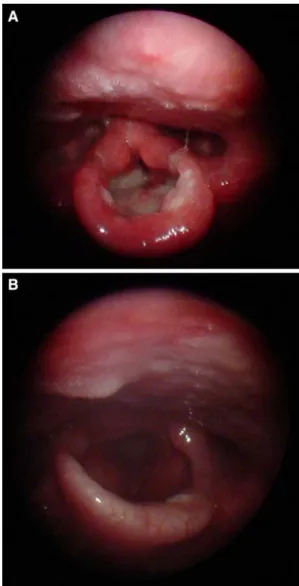 Fig. 1 This patient is a 48-year-old male with complaints of weight loss, fatigue, odynophagia, hemoptysis and foreign body sensation in the throat for the last 15 days