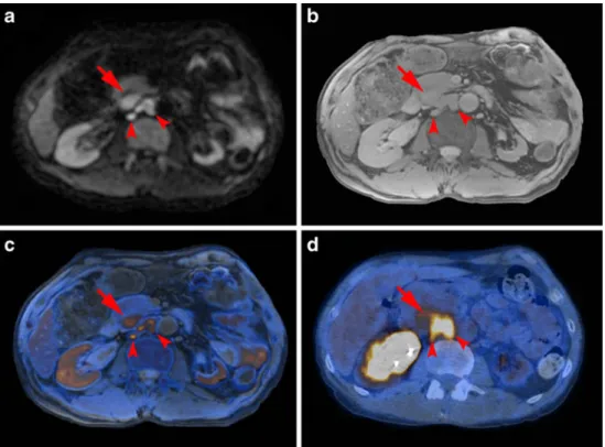 Table 2 Lesion-based diagnos- diagnos-tic accuracy for detection of malignant lesions using PET/CT as the reference standard