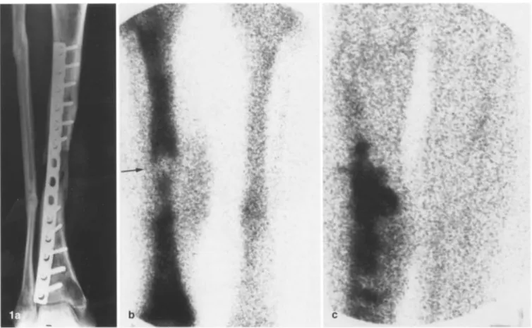 Fig.  l a - e .   True-positive result  in  a  patient with  infected pseudarthrosis  and bone  necrosis  3  years  after  trauma