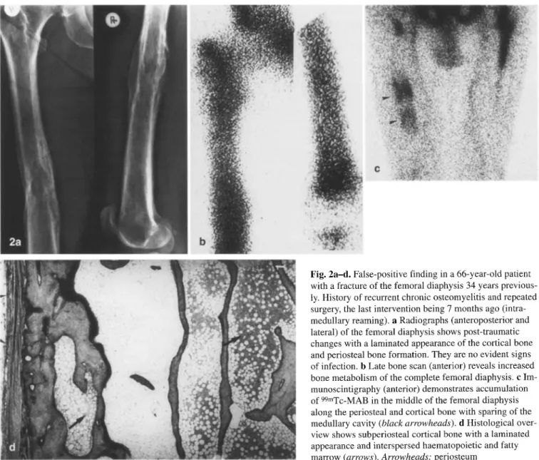 Fig.  2a-d.  False-positive  finding in a 66-year-old patient  with a fracture of the femoral diaphysis 34 years previous-  ly