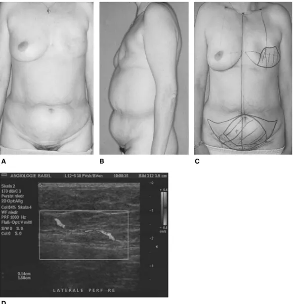 Fig. 2. (A, B) Preoperative views of a patient with a left mastectomy scar and ample abdominal tissue for breast reconstruction