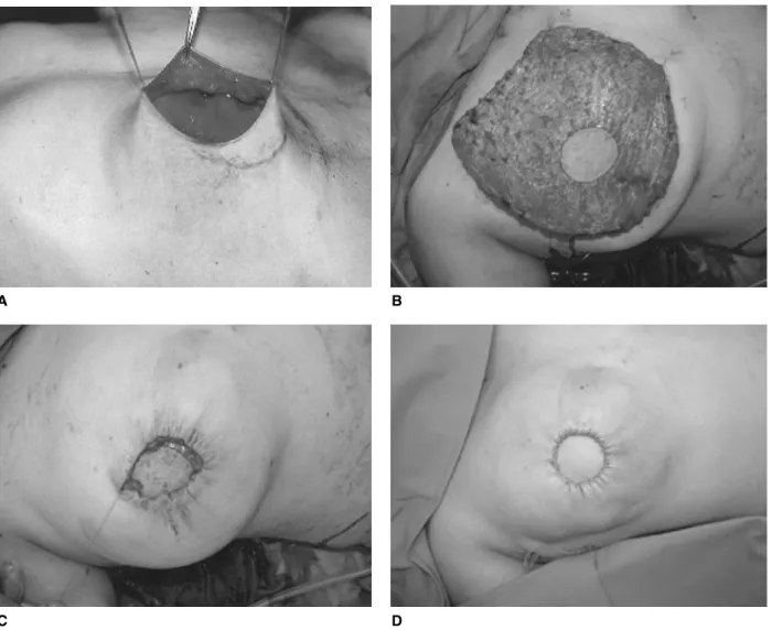 Fig. 4. (A) Situs in a primary reconstruction. The skin sparing mastectomy has been completed