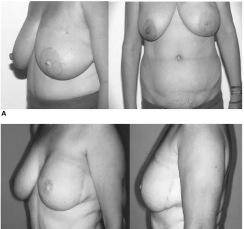 Fig. 6. (A, B) Final views of patient after delayed reconstruction, even very full breasts can be reconstructed without having to reduce the contralateral side