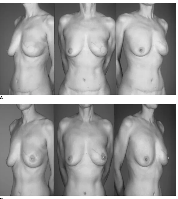 Fig. 7. (A) Primary reconstruction of left breast: result after skin sparing mastectomy and DIEAP flap and (B) NAC reconstruction after 8 weeks without any surgery to the healthy side