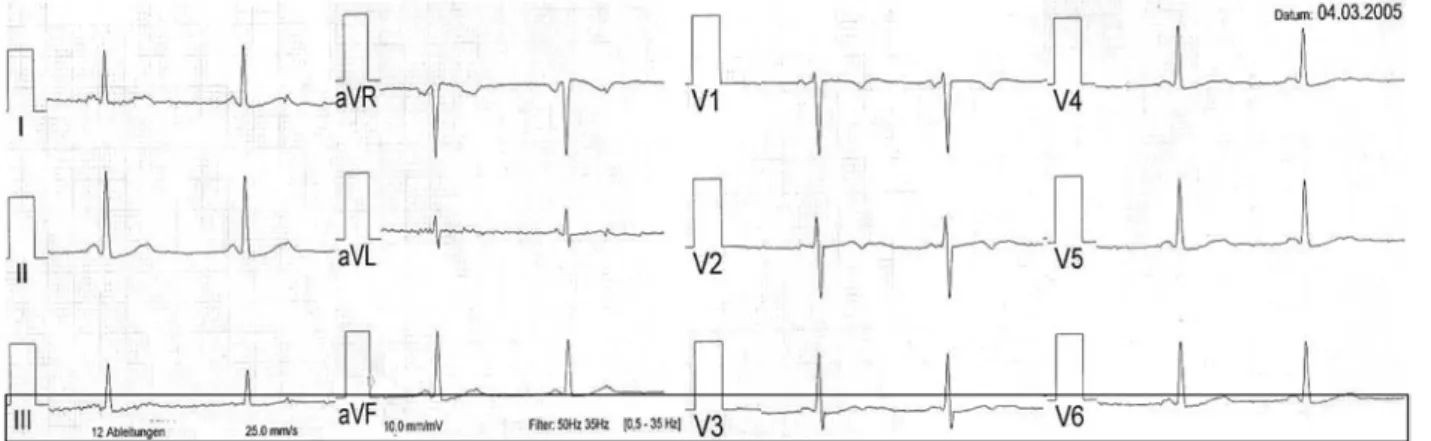 Fig. 4 The 12 lead ECG after cessation of methadone showing a QT interval of 440 ms (QTc 440 ms)