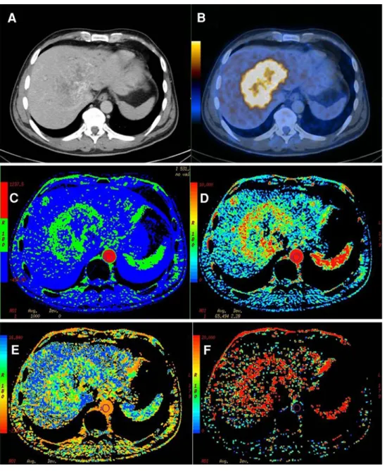 Fig. 3. Fifty y/o male patient with history of a colorectal cancer and hepatic metastases 1 week after chemotherapy