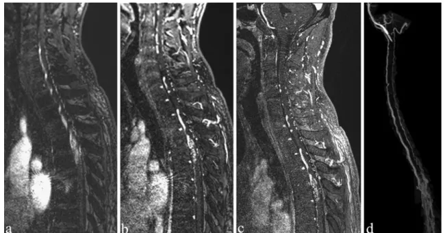 Fig. 2 A 30-year-old woman: the MRA shows clearly an AKA ( arrows , a) passing over the cyst ( asterisk , a, b)