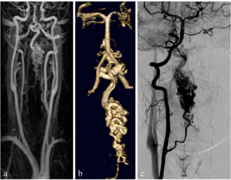 Fig. 4 A 26-year-old woman with a cervical AVM: the MRA (a) showing the feeder, nicely demonstrated in the 3D reconstruction (b), corresponding to what is seen on DSA (c)2494