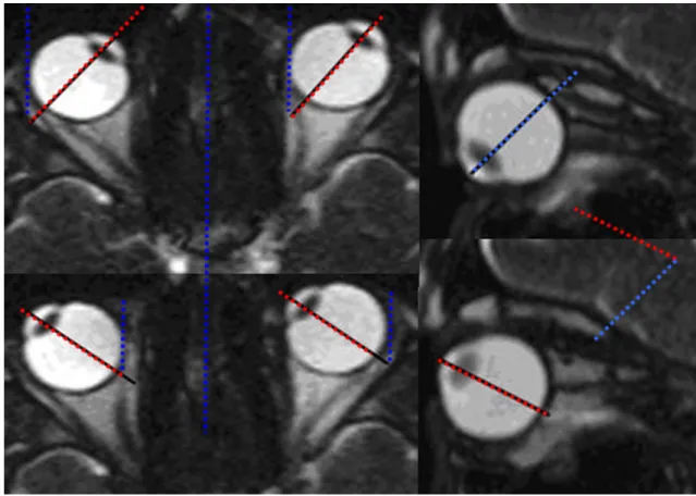 Fig. 3 Single images taken from a dynamic TrueFISP sequence. MRI measurement of the maximal monocular horizontal excursion on the right side of the figure