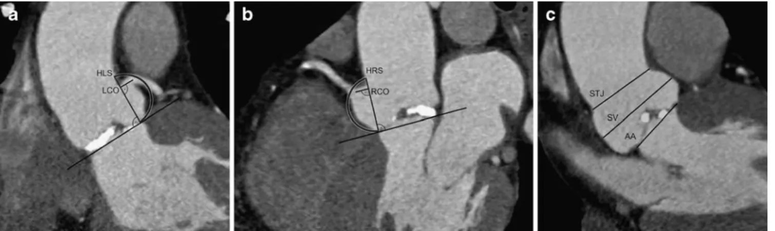 Fig. 1 Measurements of coronary ostial locations and sinus heights with CT. Coronary ostial locations of the LCO were located on an oblique coronal reformation (a) orientated orthogonally to the plane of AA