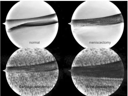 Fig. 1 Illustrations of the medial knee compartment before and after each intervention: First, a unilateral total meniscectomy was performed