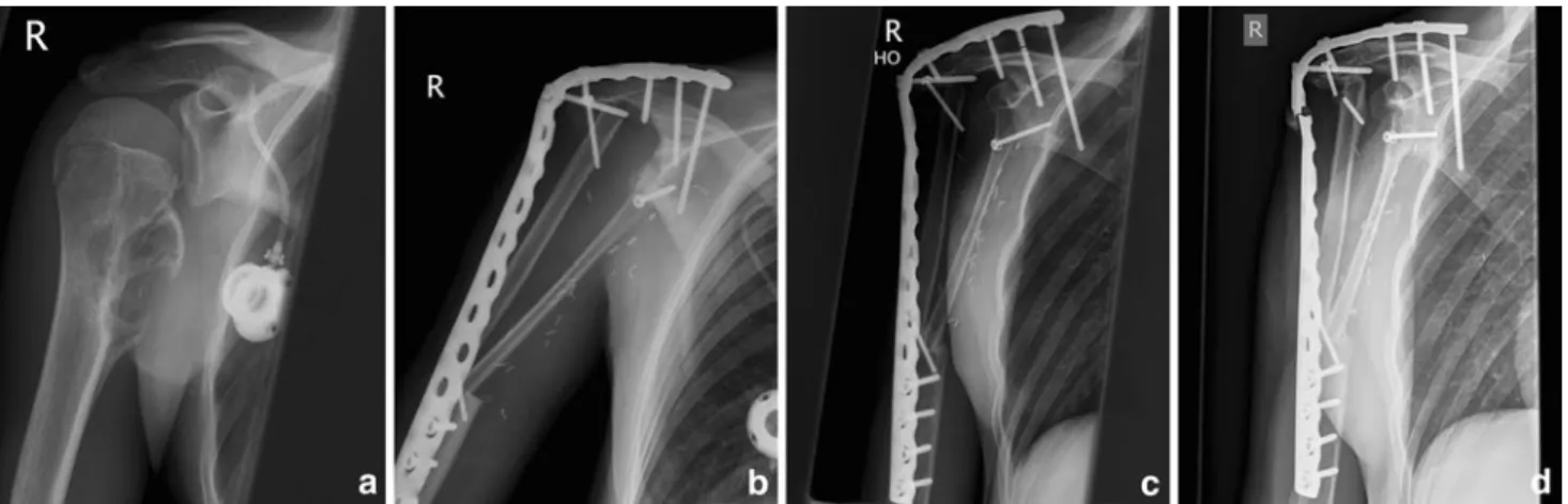 Fig. 2   Preoperative X-ray (a) of the third patient shows an osteolytic  lesion at the proximal humerus with medial cortical breakthrough