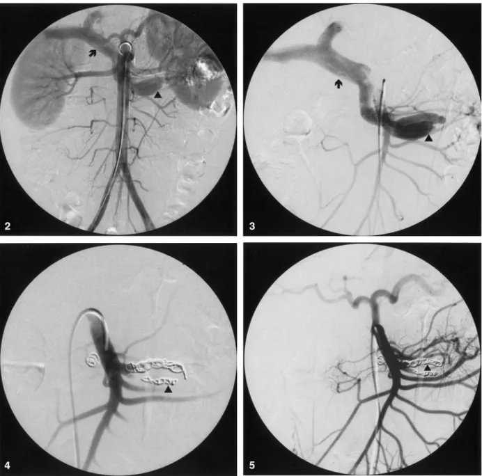 Fig. 2. Transfemoral abdominal aortography. A large arterio-venous fistula (arrowhead) from the third branch of a jejunal artery is clearly visualized