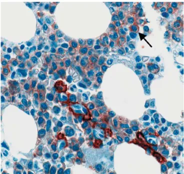 Fig. 2 Immunostaining for CD117 (40) with weak positive malignant plasma cells (arrow) and adjacent strong positive mast cells as internal control