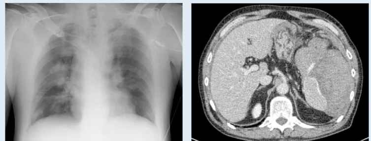 Abb. 4  9  CT-Thorax-Abdomen: pulmonale Kon-