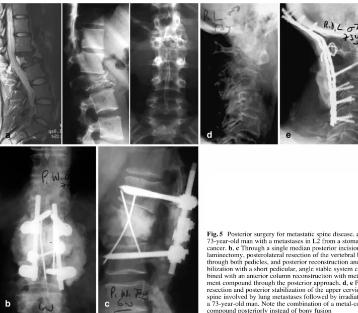 Fig. 5 Posterior surgery for metastatic spine disease. a A 73-year-old man with a metastases in L2 from a stomach cancer